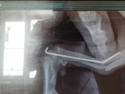 «Врач пытался сохранить кость»: в клинике Волжского прокомментировали историю с ампутацией лапы шпицу