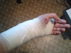 Волжанину во время выгула стаффорда откусил кусок руки владелец другой собаки