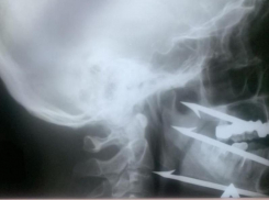 Волгоградские врачи извлекли гарпун из лица рыбака в миллиметре от сонной артерии