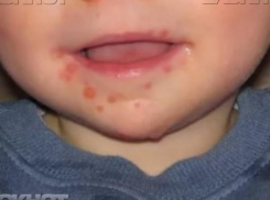 Дети болеют вирусом Коксаки, а врачи это отрицают по неизвестным причинам, - волжанка Ирина Мостовая