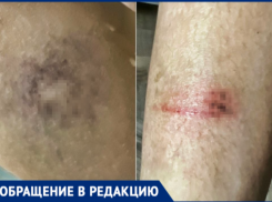 Волжанка показала фото изувеченной дочери после наезда 13-летней девочки на электросамокате