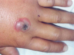 Волжанам рекомендуют сделать прививки от сибирской язвы