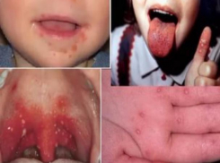 Об ужасах лихорадки Коксаки рассказала мама-блогер из Волжского