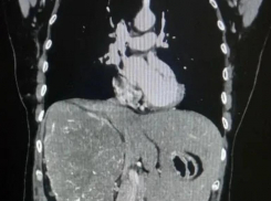 Волгоградские врачи провели сложную операцию и удалили гигантскую опухоль