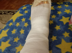 Волжанке сняли швы на дому после обращения в редакцию «Блокнот Волжский»