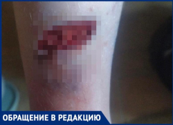 В Волжском 8-летней девочке зашивали ногу после укуса бездомной собаки