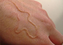 Среди заболевших дирофиляриозом есть волжане