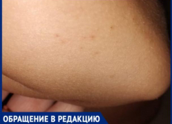 «На мою дочку напал рой ос. Около двадцати укусов в кисти, локти и ноги», - волжанка