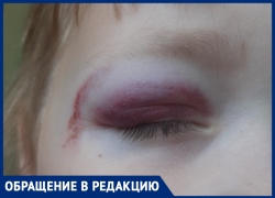 Труба на детской площадке покалечила ребенка: волжанка