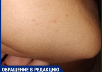 «На мою дочку напал рой ос. Около двадцати укусов в кисти, локти и ноги», - волжанка