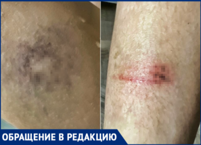 Волжанка показала фото изувеченной дочери после наезда 13-летней девочки на электросамокате