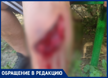 «Радуга смерти»: ребенок разорвал ногу до кости на детской площадке в Волжском