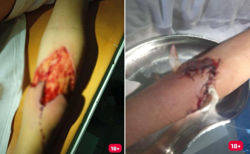 В 30 тысяч рублей оценили страдания 11-летнего волжанина с оторванной от руки плотью