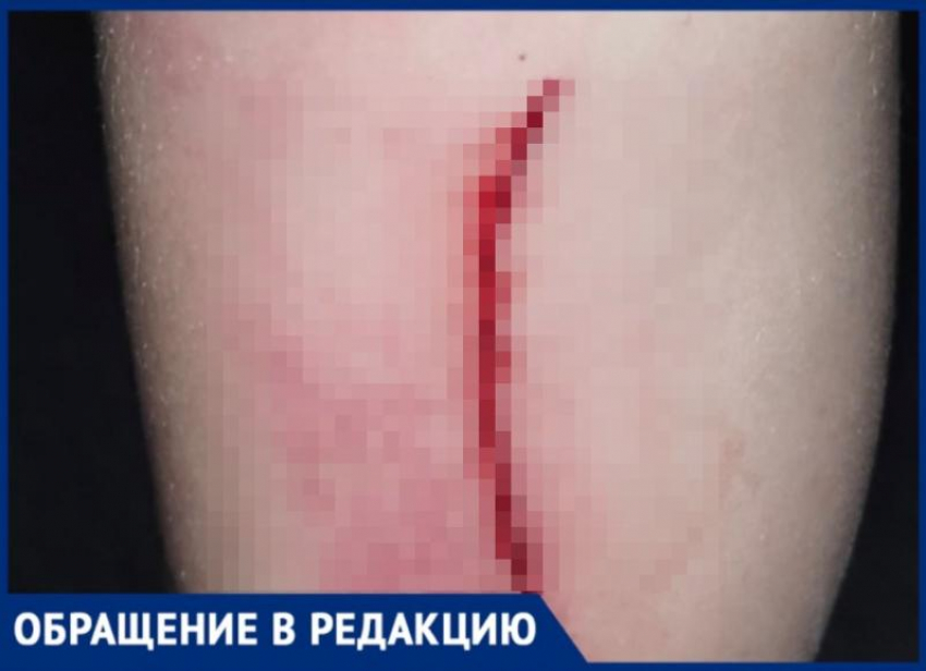 Ребенок распорол ногу на детской площадке в Волжском
