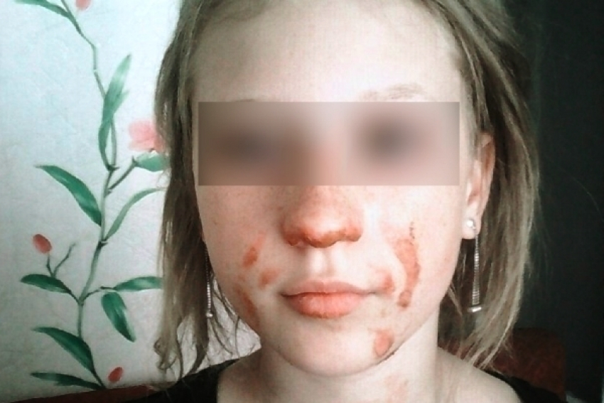 На западе Волгограда 10-летняя школьница обожгла лицо, чтобы впечатлить сверстников